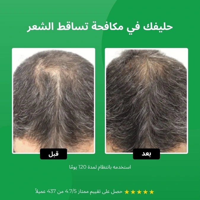 علاج تساقط الشعر - Gents